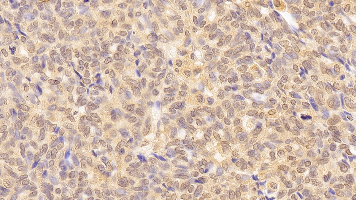 dab staining on ihc-p samples human ovarian cancer tissue